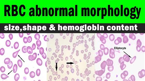 rbc morphology abnormal results|what does rbc stand for.